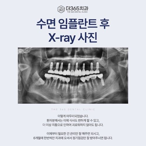 임플란트 후기 이미지