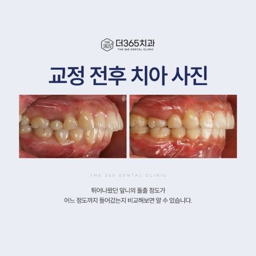 교정 후기 이미지