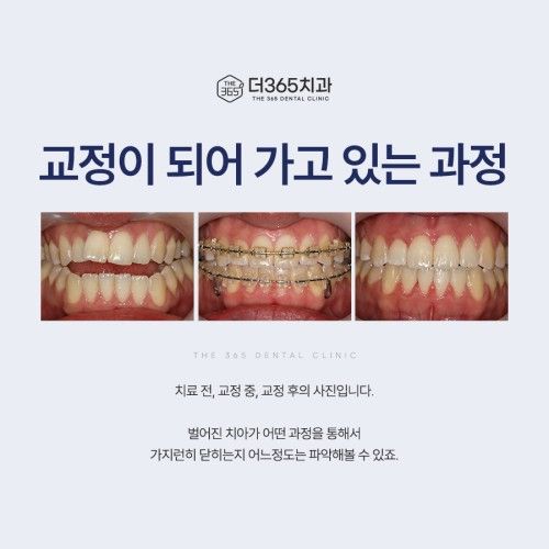 수면치료 후기 이미지
